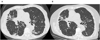 Case Report: <mark class="highlighted">Kampo Medicine</mark> for Non-tuberculous Mycobacterium Pulmonary Disease